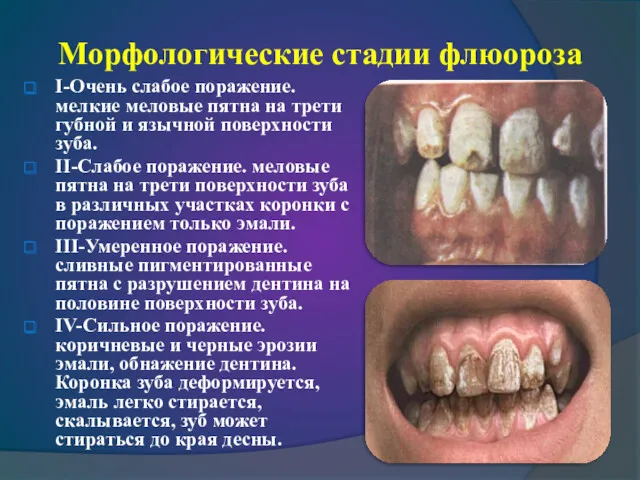 Морфологические стадии флюороза I-Очень слабое поражение. мелкие меловые пятна на