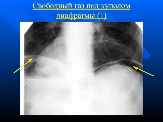 Свободный газ под куполом диафрагмы (1)