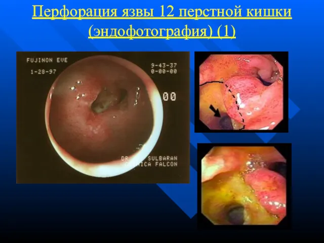 Перфорация язвы 12 перстной кишки (эндофотография) (1)