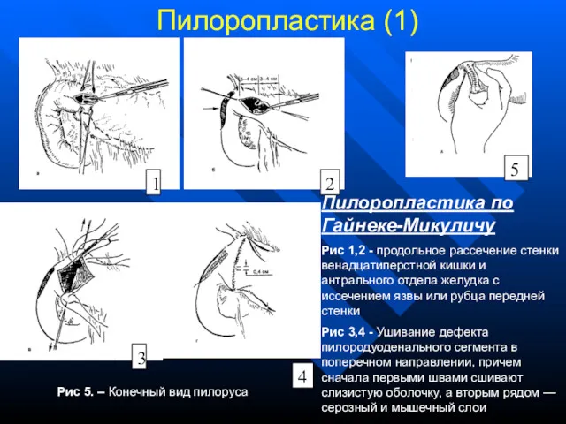 Пилоропластика (1) Пилоропластика по Гайнеке-Микуличу Рис 1,2 - продольное рассечение