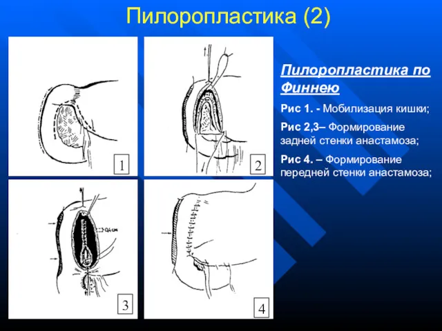 Пилоропластика (2) Пилоропластика по Финнею Рис 1. - Мобилизация кишки;