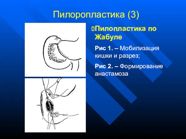 Пилоропластика (3) Пилопластика по Жабуле Рис 1. – Мобилизация кишки