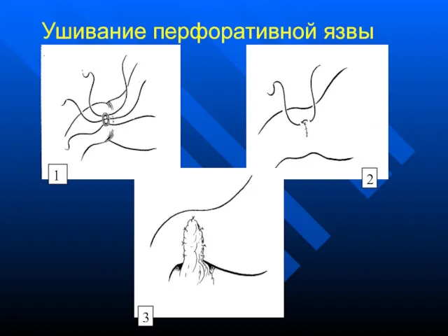 Ушивание перфоративной язвы 1 2 3