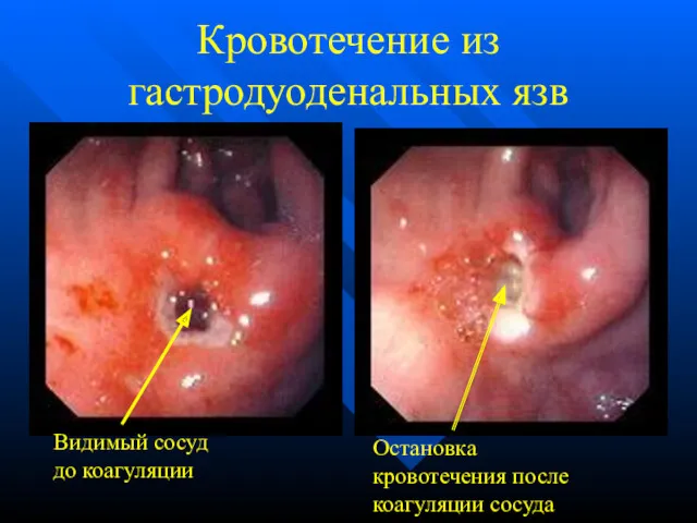 Кровотечение из гастродуоденальных язв Видимый сосуд до коагуляции Остановка кровотечения после коагуляции сосуда