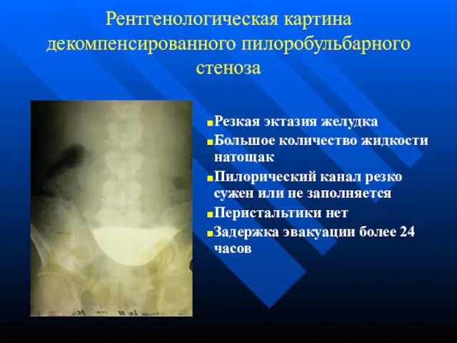 Рентгенологическая картина декомпенсированного пилоробульбарного стеноза Резкая эктазия желудка Большое количество