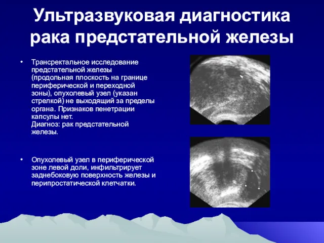 Ультразвуковая диагностика рака предстательной железы Трансректальное исследование предстательной железы (продольная плоскость на границе