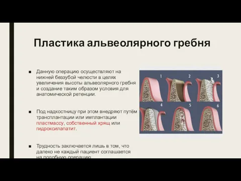 Пластика альвеолярного гребня Данную операцию осуществляют на нижней беззубой челюсти