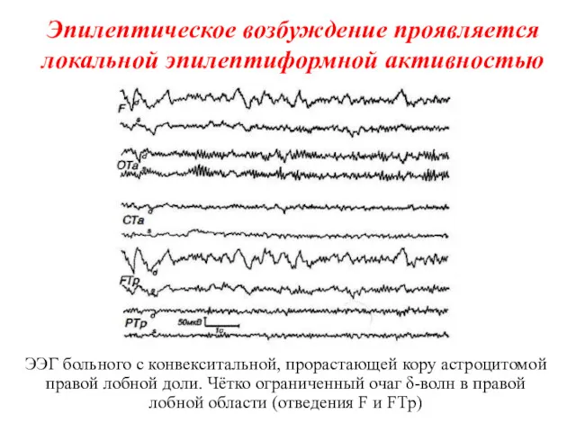 Эпилептическое возбуждение проявляется локальной эпилептиформной активностью ЭЭГ больного с конвекситальной,