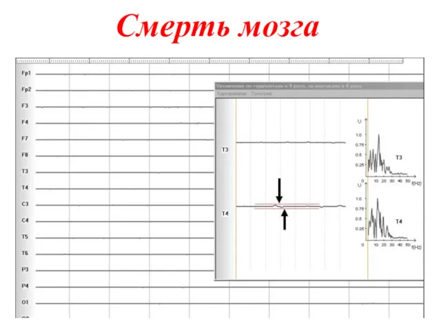 Смерть мозга