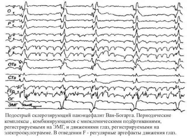 Подострый склерозирующий панэнцефалит Ван-Богарта. Периодические комплексы , комбинирующиеся с миоклоническими