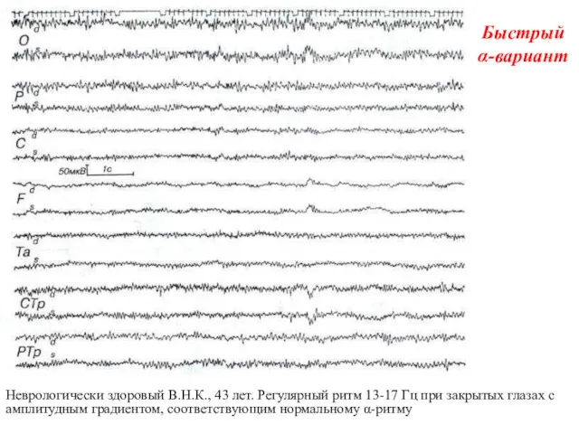 Быстрый α-вариант Неврологически здоровый В.Н.К., 43 лет. Регулярный ритм 13-17