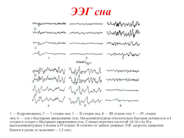 ЭЭГ сна 1 — бодрствование; 2 — 1 стадия сна;