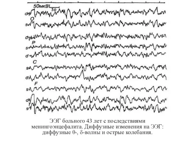 ЭЭГ больного 43 лет с последствиями менингоэнцефалита. Диффузные изменения на