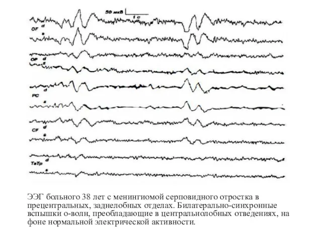 ЭЭГ больного 38 лет с менингиомой серповидного отростка в прецентральных,