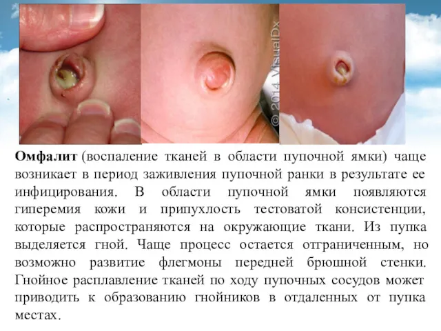 Омфалит (воспаление тканей в области пупочной ямки) чаще возникает в