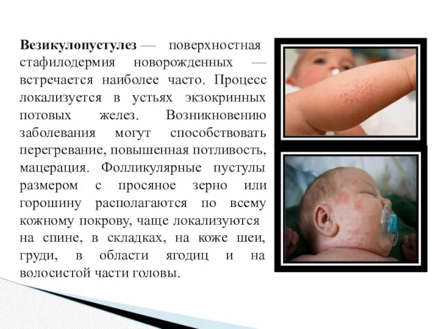 Везикулопустулез — поверхностная стафилодермия новорожденных — встречается наиболее часто. Процесс