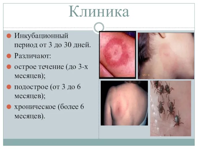 Клиника Инкубационный период от 3 до 30 дней. Различают: острое