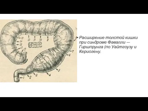 Расширение толстой кишки при синдроме Фавалли — Гиршпрунга (по Уайтгоузу и Кериогену.