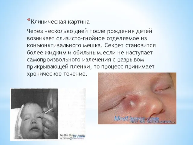 Клиническая картина Через несколько дней после рождения детей возникает слизисто-гнойное