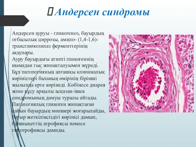 Андерсен ауруы - гликогеноз, бауырдың отбасылық циррозы, амило- (1,4-1,6)-трансглюкозилаз ферменттерінің