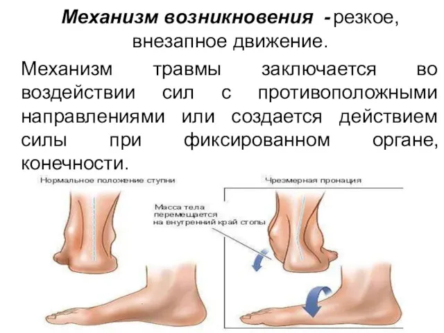 Механизм возникновения - резкое, внезапное движение. Механизм травмы заключается во