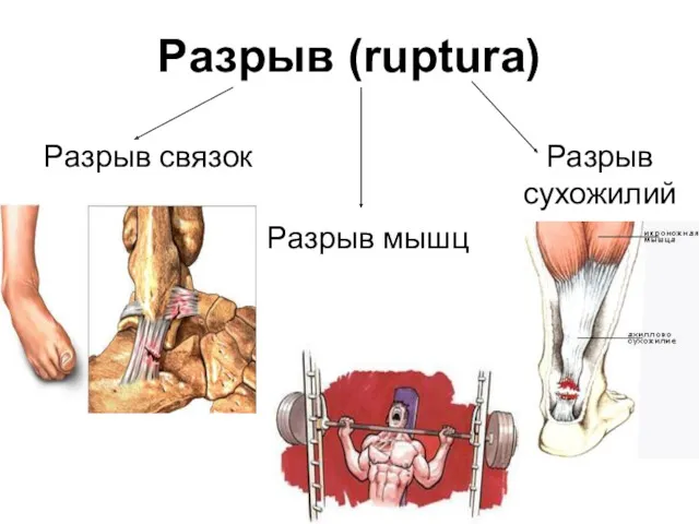 Разрыв (ruptura) Разрыв связок Разрыв мышц Разрыв сухожилий