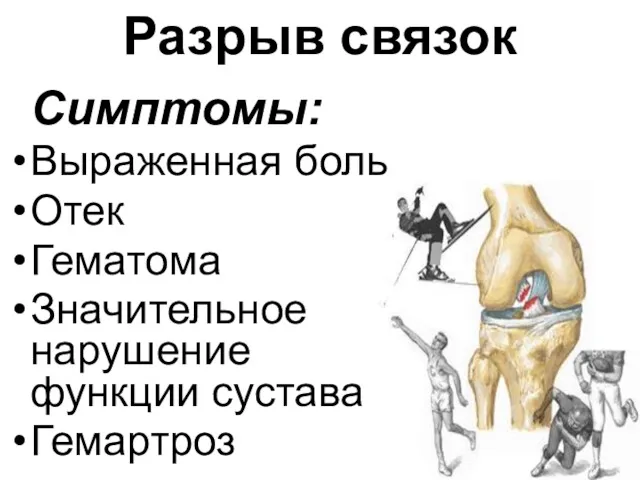 Разрыв связок Симптомы: Выраженная боль Отек Гематома Значительное нарушение функции сустава Гемартроз