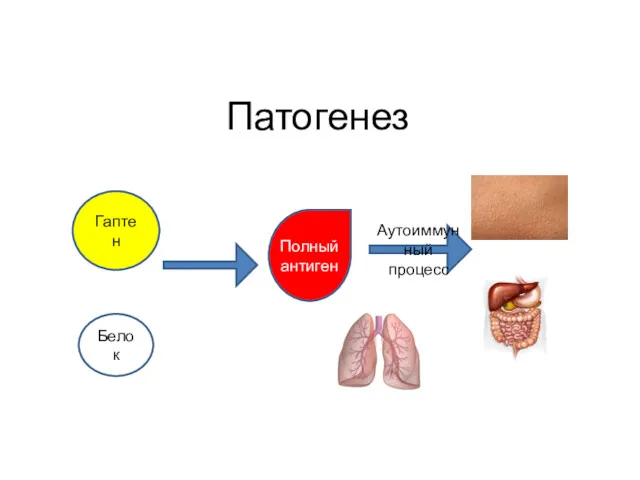 Патогенез Гаптен Белок Полный антиген Аутоиммунный процесс