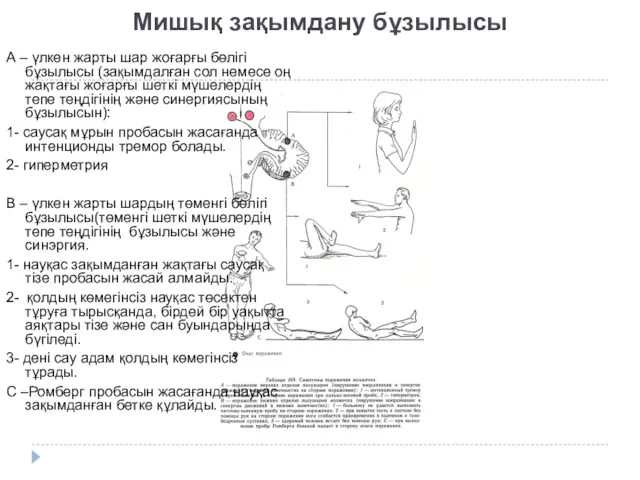 Мишық зақымдану бұзылысы А – үлкен жарты шар жоғарғы бөлігі