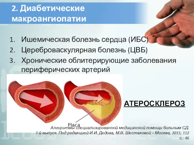 Ишемическая болезнь сердца (ИБС) Цереброваскулярная болезнь (ЦВБ) Хронические облитерирующие заболевания