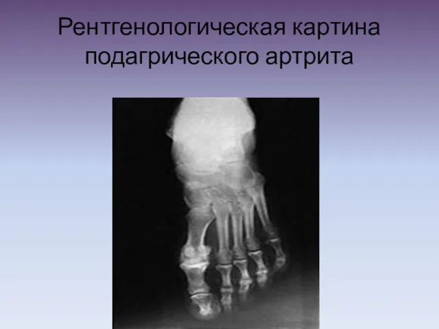 Рентгенологическая картина подагрического артрита