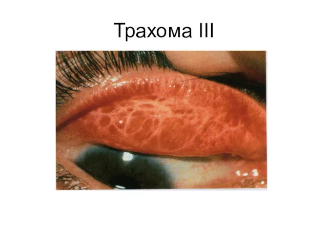 Трахома III