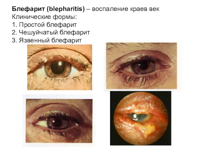 Блефарит (blepharitis) – воспаление краев век Клинические формы: 1. Простой блефарит 2. Чешуйчатый