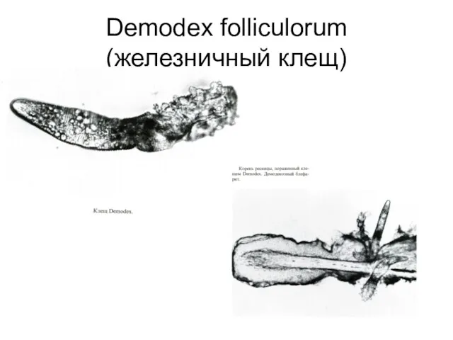 Demodex folliculorum (железничный клещ)