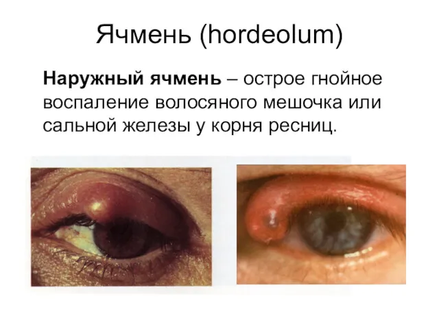 Ячмень (hordeolum) Наружный ячмень – острое гнойное воспаление волосяного мешочка или сальной железы у корня ресниц.