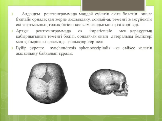 Алдыңғы рентгенграммада маңдай сүйегін екіге бөлетін sutura frontalis орналасқан жерде