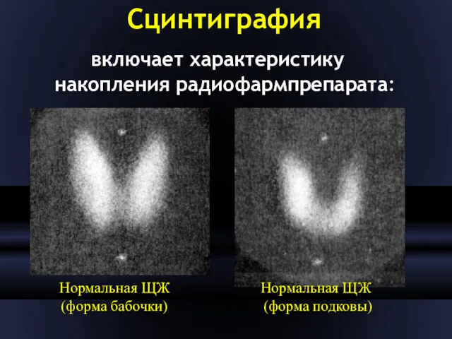 Сцинтиграфия включает характеристику накопления радиофармпрепарата: Нормальная ЩЖ (форма бабочки) Нормальная ЩЖ (форма подковы)