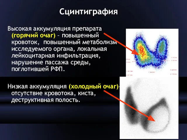 Сцинтиграфия Высокая аккумуляция препарата (горячий очаг) – повышенный кровоток, повышенный