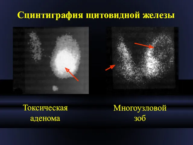 Сцинтиграфия щитовидной железы Токсическая аденома Многоузловой зоб