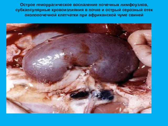 Острое геморрагическое воспаление почечных лимфоузлов, субкапсулярные кровоизлияния в почке и