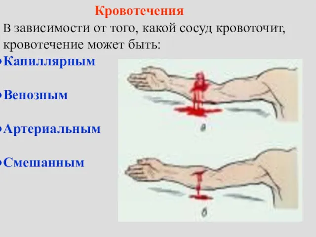 Кровотечения В зависимости от того, какой сосуд кровоточит, кровотечение может быть: Капиллярным Венозным Артериальным Смешанным