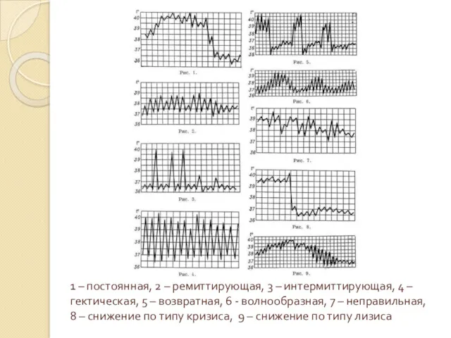 1 – постоянная, 2 – ремиттирующая, 3 – интермиттирующая, 4