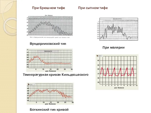 При брюшном тифе При сыпном тифе При малярии Вундерлиховский тип Температурная кривая Кильдюшеского Боткинский тип кривой