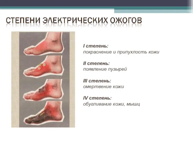 I степень: покраснение и припухлость кожи II степень: появление пузырей III степень: омертвение