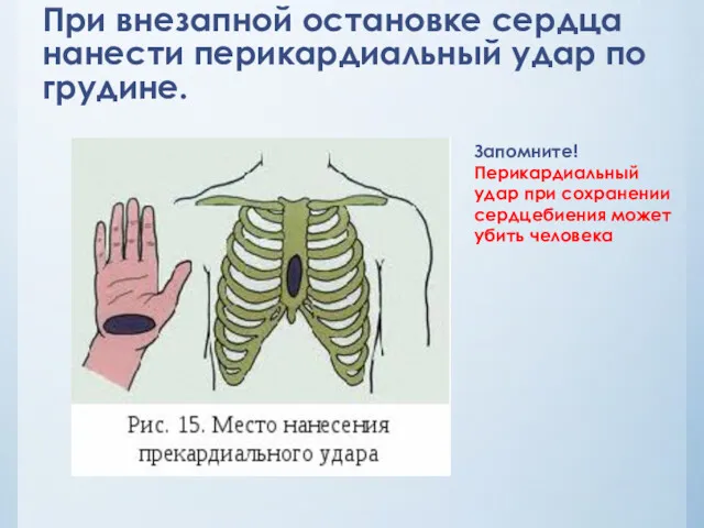 При внезапной остановке сердца нанести перикардиальный удар по грудине. Запомните!