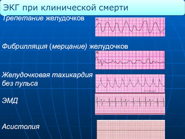 Трепетание желудочков Фибрилляция (мерцание) желудочков Желудочковая тахикардия без пульса ЭМД Асистолия