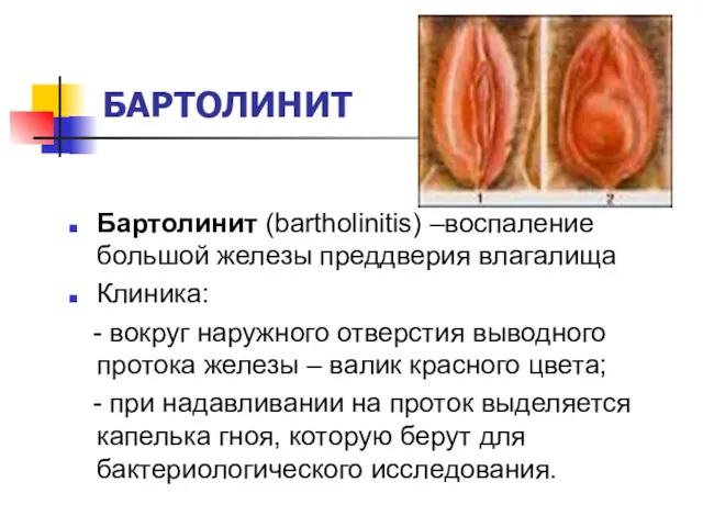 БАРТОЛИНИТ Бартолинит (bartholinitis) –воспаление большой железы преддверия влагалища Клиника: -