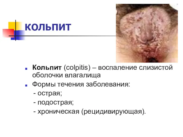 КОЛЬПИТ Кольпит (colpitis) – воспаление слизистой оболочки влагалища Формы течения