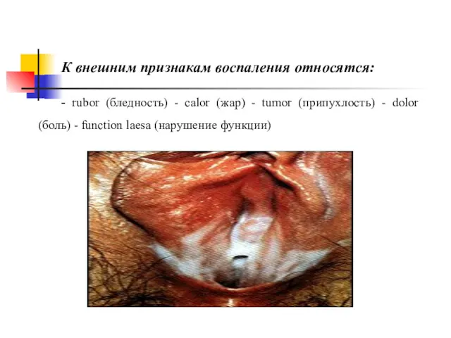 К внешним признакам воспаления относятся: - rubor (бледность) - calor