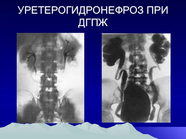 УРЕТЕРОГИДРОНЕФРОЗ ПРИ ДГПЖ